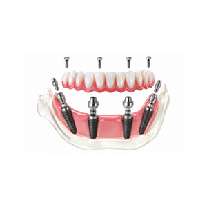 Dental Implant Kit